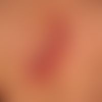 Basal cell carcinoma superficial: slowly growing, symptom-free red plaque with crusty edges, whic...