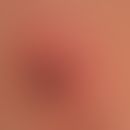Lme-Borreliose: Zeckenstich mit initialem Erythema chronicum migrans (Borrelien konnten in der Ze...