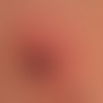 Lme-Borreliosis: Tick bite with initial erythema chronicum migrans (Borrelia could be detected in...