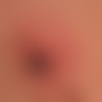Lme-Borreliose: Zeckenstich mit initialem Erythema chronicum migrans (Borrelien konnten in der Ze...
