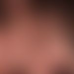 Folliculitits decalvans: scarring alopecia with shiny hairless area and tufts of hair at the edge...