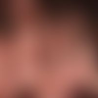 Folliculitits decalvans: scarring alopecia with shiny hairless area and tufts of hair at the edge...