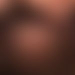 Folliculitits decalvans: scarring alopecia with shiny hairless area and tufts of hair at the edges.
