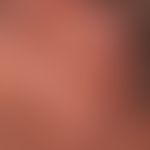 2Basal cell carcinomanodular: Nodule existing for several years, completely without symptoms, siz...