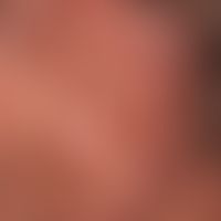 2Basalzellkarzinom knotiges:&nbsp;seit&nbsp; mehreren Jahren langsam wachsender, völlig symptomlo...