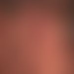 Basal cell carcinoma nodular: Nodule existing for several years, completely without symptoms, siz...