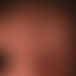 Cutis verticis gyrata: cerebriform thickenings, furrows and folds of the capillitium which have e...