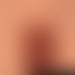 Nodules/Condylomata acuminata: in the 22-year-old patient these brownish, partly isolated, partly...
