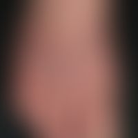 Nummular dermatitis (nummular/microbial eczema): chronically active, itchy, brownish-greyish, fla...