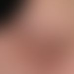 Nummuläre Dermatitis (nummuläres/mikrobielles Ekzem):&nbsp; chronisch aktive, seit 8 Wochen beste...