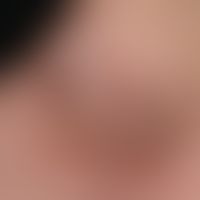 Nummular dermatitis ( nummular/microbial eczema): Chronically active, 8-week-old, approx. 8 cm ta...