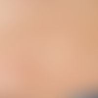 Erythema anulare centrifugum: offenabr im Abklingen begriffene, chronisch aktive, zentrifugal wac...