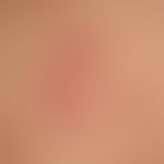 Erythema anulare centrifugum: charakteristische (frische) Läsionen mit peripher fortschreitenden ...