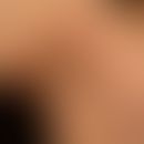 Erythema anulare centrifugum: multiple, chronically active, centrifugally growing, ubiquitous, no...