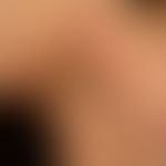 Erythema anulare centrifugum:&nbsp;multiple, chronisch aktive, zentrifugal wachsende, ubiquitäre,...