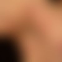 Erythema anulare centrifugum: multiple, chronically active, centrifugally growing, ubiquitous, no...