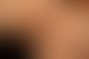 Erythema anulare centrifugum: multiple, chronically active, centrifugally growing, ubiquitous, no...