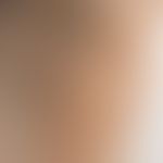 Stain brown: homogeneously brown, chronic, non-inflammatory, non-marginized stain Diagnosis: Eryt...