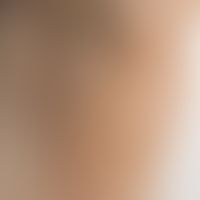 Stain brown: homogeneously brown, chronic, non-inflammatory, non-marginized stain Diagnosis: Eryt...