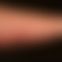 Acute allergic contact dermatitis: acute, itchy, blurred dermatitis of the right forearm that app...