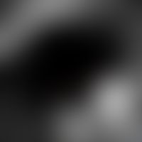 Comedo: Identical hair follicle in the corium, perforating there, laser scanning microscopy, - se...
