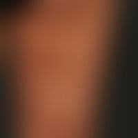 Scleroderma ligamentous: for years slowly progressive, only moderately indurated ligamentous morp...