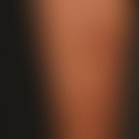 Scleroderma ligamentous: for years slowly progressive, only moderately indurated ligamentous morp...