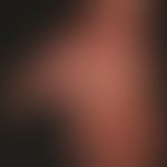 Psoriasis palmaris et plantaris (plaquet type): long-term chronic inpatient infection of the palm...