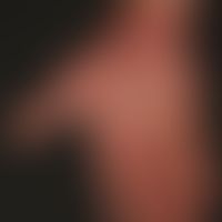 Psoriasis palmaris et plantaris (Plaquetyp): langzeitig chronisch stationärer Befall der Handfläc...