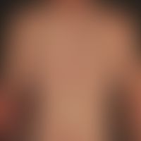 Relapsing activity in chronic psoriasis: psoriasis known for a long time. 4 weeks (post-infection...
