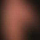 Dupuytren's contracture: 2nd degree with minor obstruction of the extension of the finger in the ...