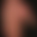 Dupuytren's contracture: 2nd degree with minor obstruction of the extension of the finger in the ...