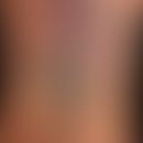 Lymphomatoide Hyperplasie nach Tätowierung mit einem (nicht mehr identifizierbaren) roten Farbsto...