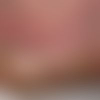 Rhagade: mehrere tiefe, sehr schmerzhafte Rhagaden bei schwerer Psoriasis plantaris.
