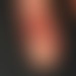 Carcinoma verrucous: long term unrecognised and treated as a "viral wart" In the presented case a...