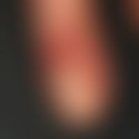 Karzinom verruköses: langzeitig als "Viruswarze"&nbsp; verkannt und behandelt. Im vorlegenden Fal...
