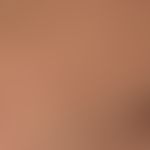 generalized clinical picture: surface smooth plaques, which dissect at the edges, with clear evid...