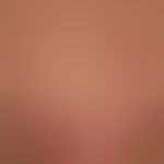 Mycosis fungoides follikulotrope: generalised clinical picture; smooth plaques that dissect at th...