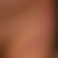 Mycosis fungoides follikulotrope: generalised clinical picture; smooth plaques that dissect at th...