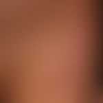 Folliculotropic Mycosis fungoides: generalized picture of the disease with smooth plaques that di...