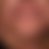 Mycosis fungoides follikulotrope: generalisertes Krankheitsbild; seit etwa 8 Wochen massivee schm...