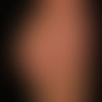 Lichen planus exanthematicus: small papular lichen planus, aggregation of the efflorescences to l...