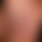 Lichen planus exanthematicus: Detailed section with circumscribed infestation of the sole of the ...