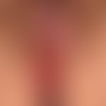 Lichen planus vulvae: extensive erosion of the large and small labia. considerable burning and al...