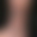 Lichen planus verrucosus: Large, coarse, brownish to brownish-red plaques with a verrucous surfac...