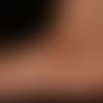 Pronounced livedo racemosa: Intermediate findings after 2 more years (period of clinical follow-u...