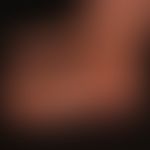 Pronounced livedo racemosa: with a clinical course over 8 years. Extremely painful red, reticular...