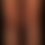 Livedo racemosa: irregular, bizarre, non-closed circle segments, as pioneering morphological indi...