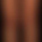 Livedo racemosa : irregular, bizarre non-closed circle segments, as pioneering morphological indi...