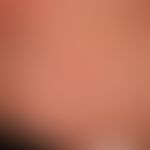 Sweet Syndrome: reddish-livid, succulent, pressure-dolent, infiltrated, solitary and partly papul...